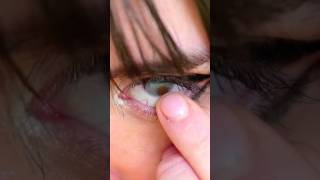 Nimu Tienes Heterocromia?