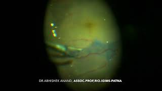 Sub Pfcl Ilm Peeling Along With Star Fold Removal