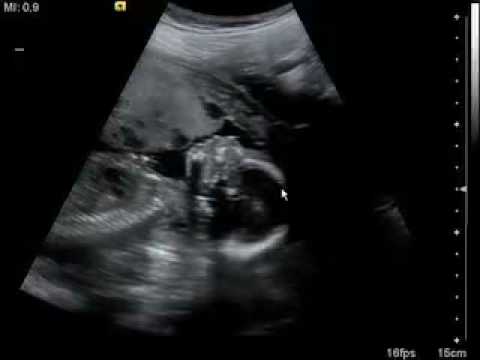 3d ultrasound pictures at 12 weeks. 3D/4D Ultrasound at 15 weeks.