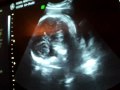 39 Weeks Pregnant Sonogram