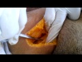 embalming