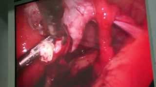 Laparoscopia cirúrgica para cisto dermóide ovariano/ Laparoscopic surgery for ovarian dermoid cyst