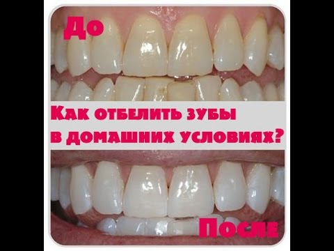 Как отбелить зубы в домашних условиях за один час без вреда