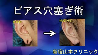 ピアス穴ふさぎも山本クリニックへ☆
