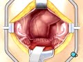 PreOp® Patient Education: Hysterectomy Removal Uterus 2