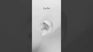 8 Congenital Ear Deformities