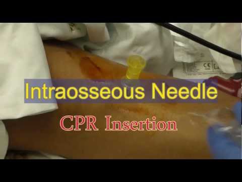 Intraosseous