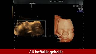 36 haftalık (8.5 aylık) gebelik. Rahimde bebeğin HD ( yüksek çözünürlüklü) 4 boyutlu görüntüleri.