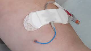 Picc Line Prélèvement Et Pant