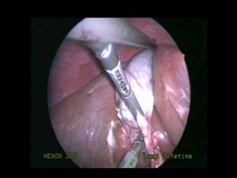 single incision laparosc**y