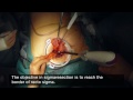 Single incision sigmoidectomy via hand port (SISVHP)