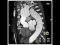 Cardiac: aneurysm of the ascending aorta and the arch (8 of 8)