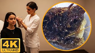 Hard Black Earwax Removal Deep Asmr Ear Cleaning For Relaxation