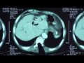 20090706-bile stone intestinal obstruction AVCHD.mpg