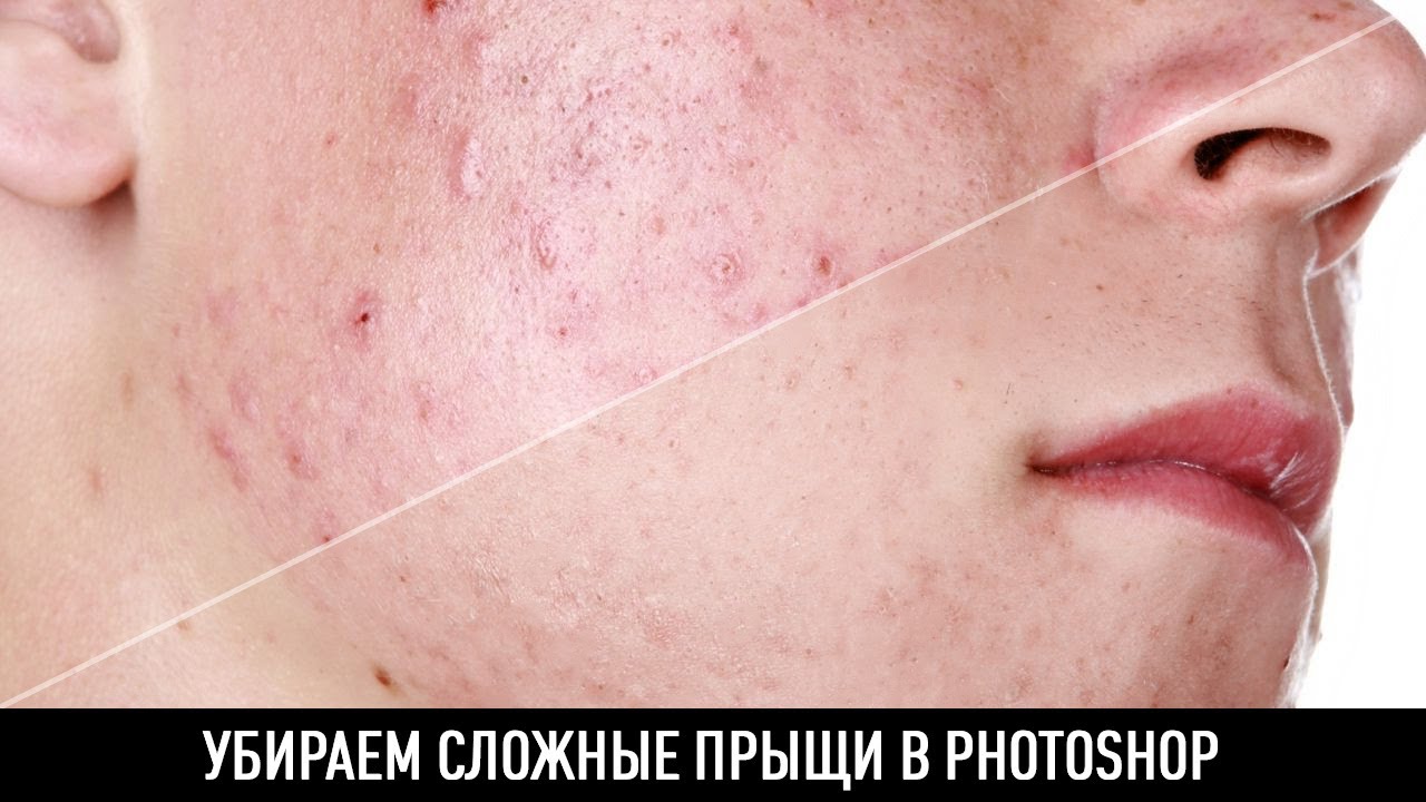 Как убрать прыщи в домашних условиях для подростков Как убрать прыщи в домашних условиях для подростков