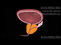 Benign Prostatic Hyperplasia (BPH) and Treatments, animation.