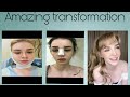 A beautiful tranformation of "JESSIE VARD" before and after surgery