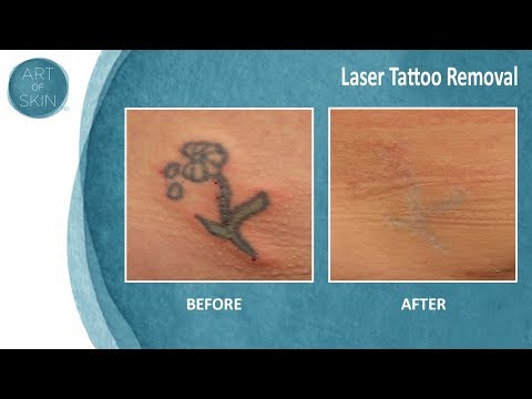 Color Tattoo Removal San Diego with Spectra Laser Dr. Melanie Palm Art ...