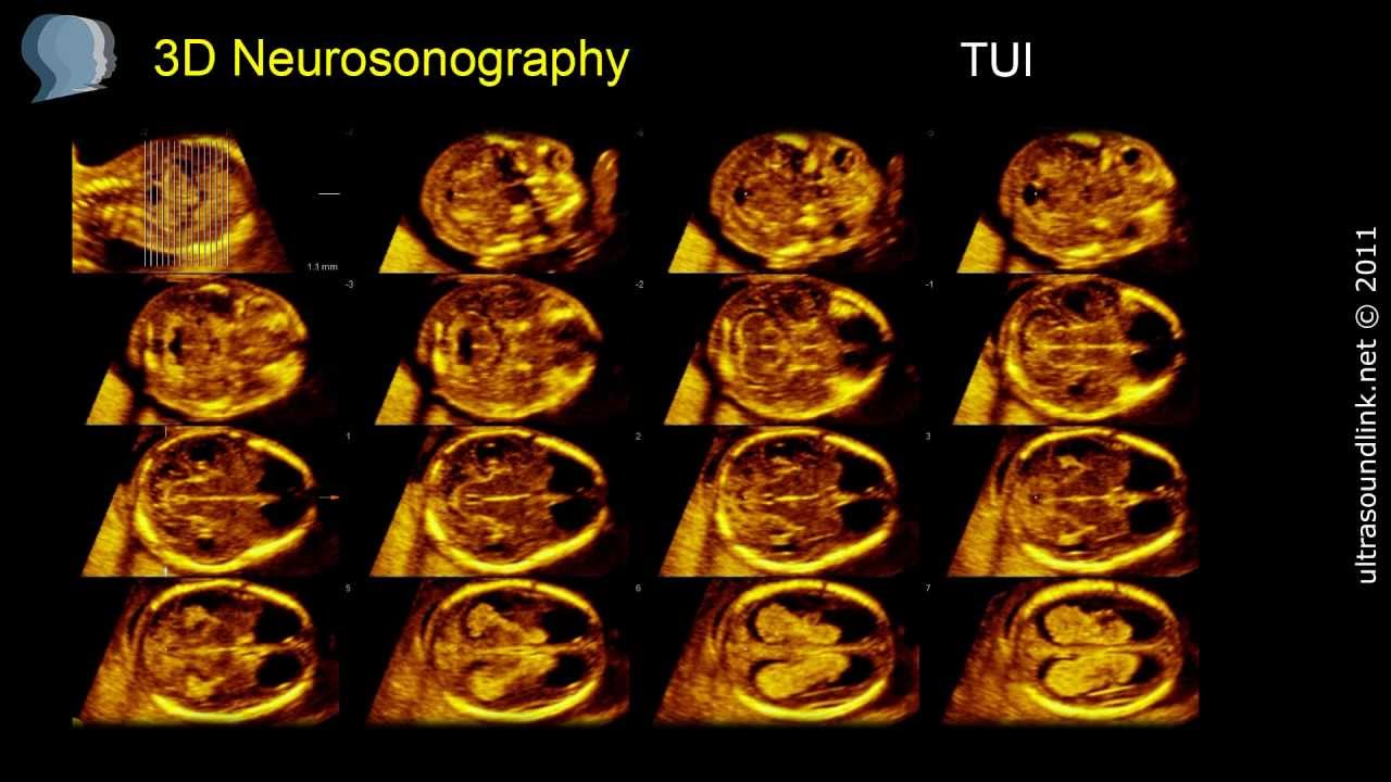 The 12 Weeks Scan: 3D and 4D Ultrasound - YouTube