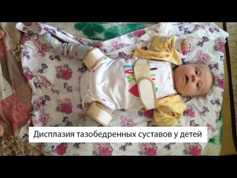 дисплазия тазобедреных суставов ребенку 3 месяца дисплазия тазобедреных суставов ребенку 3 месяца
