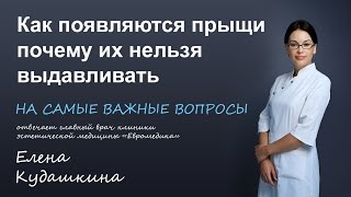 Как выдавливать прыщи и угри Как выдавливать прыщи и угри