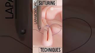 Laparoscopic Suturing Techniques