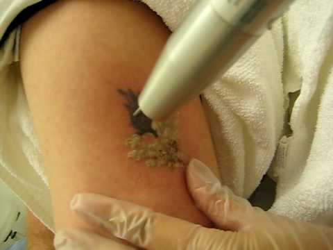 snl tattoo removal