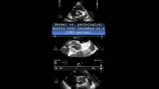 Normal Vs Pathological Aortic Root Thrombus In A Patient With Lvad