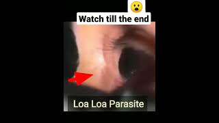 Subconjuntival Loa Loa- African Eye Worm