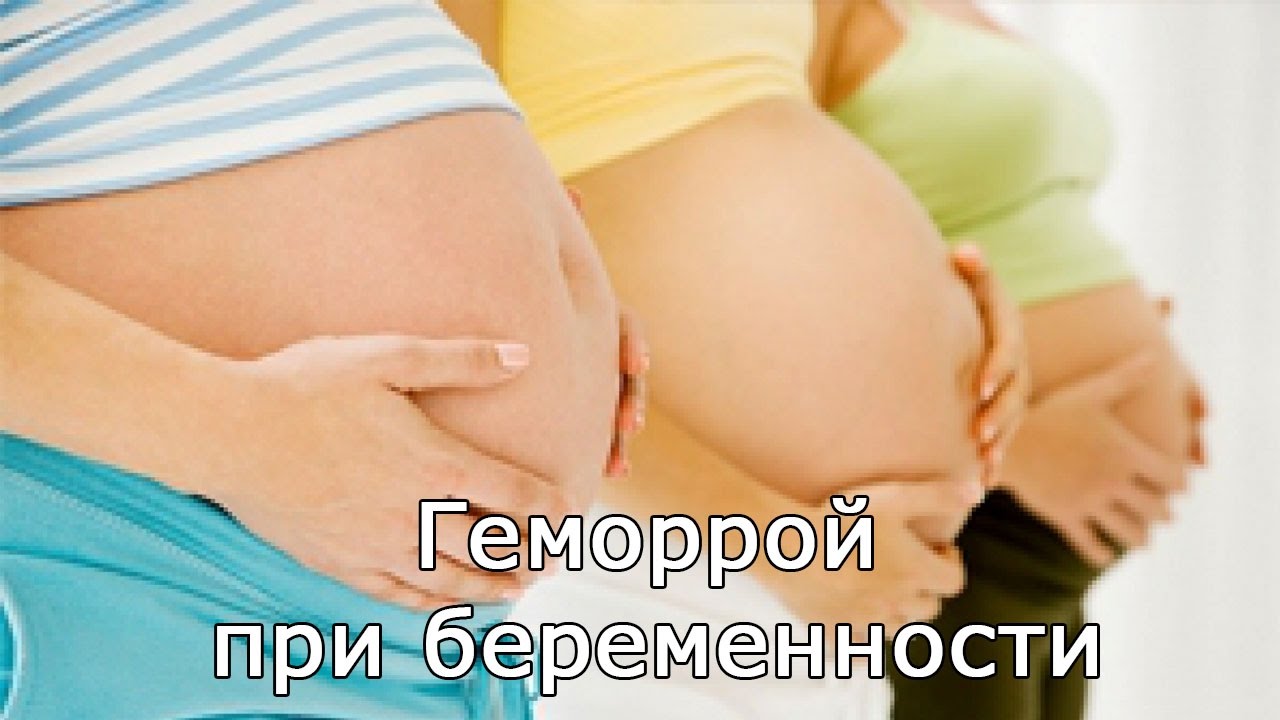Лечение геморроя у беременных в домашних 66