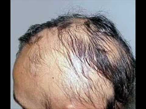 El champú contra la caída de los cabello comprar en harkove