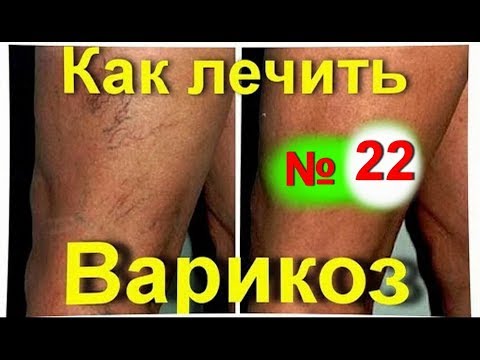Варикоз ног чем лечить в домашних условиях Варикоз ног чем лечить в домашних условиях