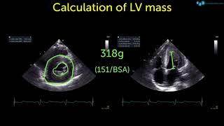 60 Seconds Of Echo Teaching - Hypertension