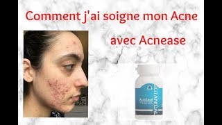 Ma Solution Contre Lacne Acnease