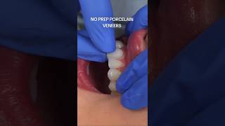 Instant Veneers With No Teeth Damage?