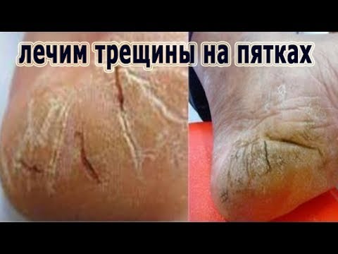 Лечение трещин на пятках в домашних условиях глицерин Лечение трещин на пятках в домашних условиях глицерин