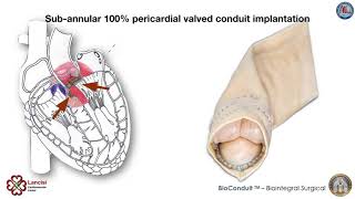 Aortic root endocarditis: a Biointegral Bioconduit subannular implantation