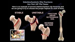 Intertrochanteric Hip Fractures , Not The Same - Everything You Need To Know - Dr. Nabil Ebraheim