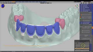 B4D Crown Module- Six Veneers