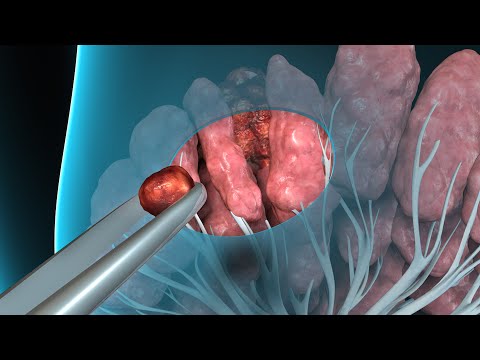 Biopsy Video