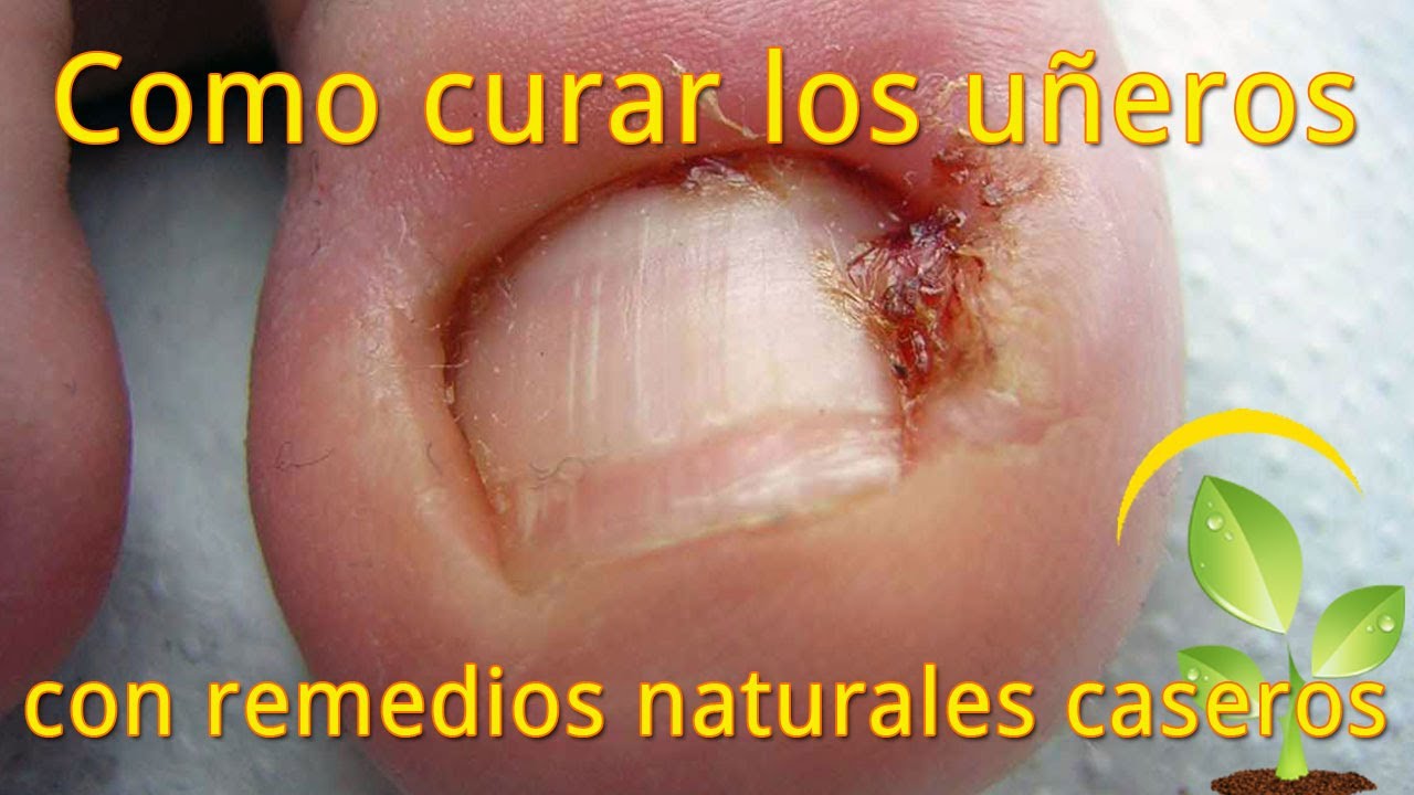 El tratamiento real del hongo de las uñas el foro