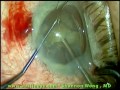Cataract surgery, pupilloplasty, removal of dense posterior subcapsular plaque. 5-15-13