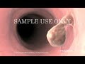 Colon Surgery