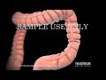 Colon Surgery