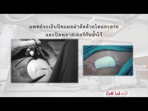 การใส่เครื่องกระตุ้นไฟฟ้าหัวใจ