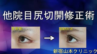 【韓国整形の目尻切開でを失敗】赤くめくれた目尻の修正手術