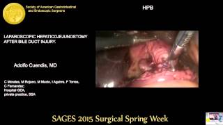 Aparoscopic Hepaticojejunostomy After Bile Duct Injury