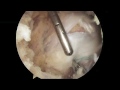 Endoscopic Abductor (Gluteus Medius) Repair