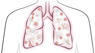 See How A Cytokine Storm Can Impact Covid-19 Patients What Do Il-6 Levels Tell You?