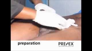 PrePex Procedure Video- safe male circumcision (no surgery)